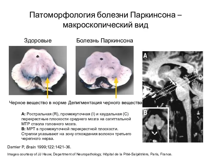 Патоморфология болезни Паркинсона – макроскопический вид Damier P, Brain 1999;122:1421-36. Images courtesy of