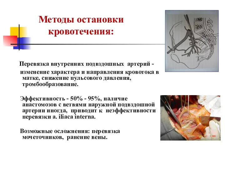 Методы остановки кровотечения: Перевязка внутренних подвздошных артерий - изменение характера