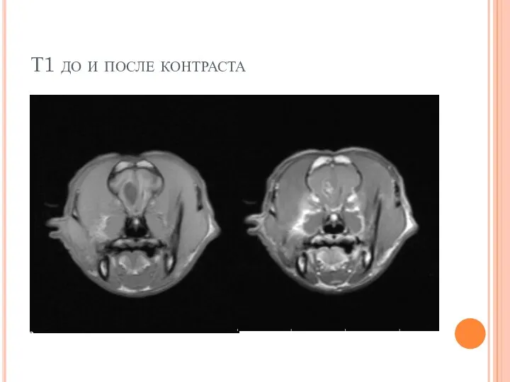 Т1 до и после контраста