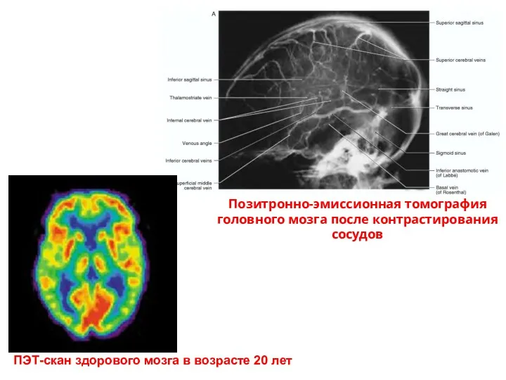 ПЭТ-скан здорового мозга в возрасте 20 лет Позитронно-эмиссионная томография головного мозга после контрастирования сосудов