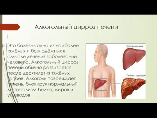 Алкогольный цирроз печени Это болезнь одна из наиболее тяжёлых и