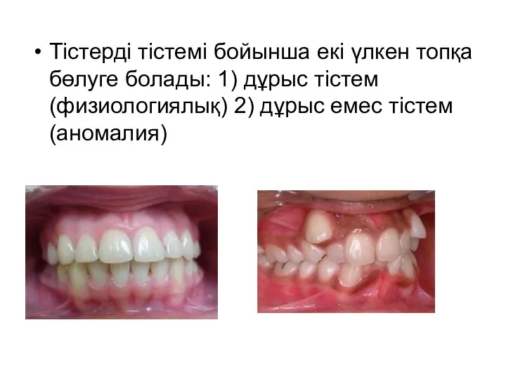 Тістерді тістемі бойынша екі үлкен топқа бөлуге болады: 1) дұрыс