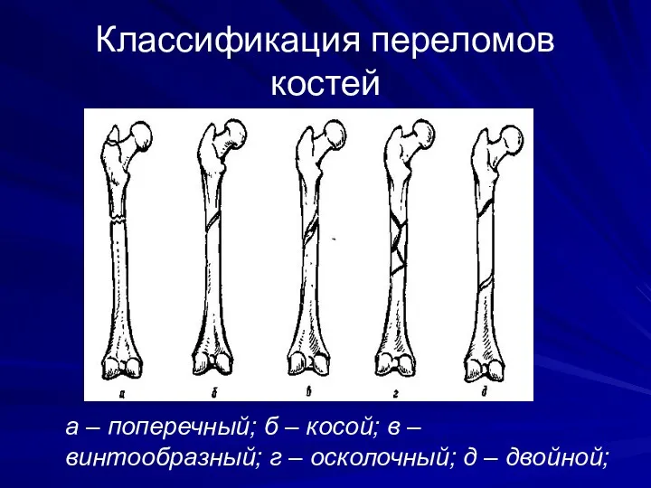 Классификация переломов костей а – поперечный; б – косой; в – винтообразный; г