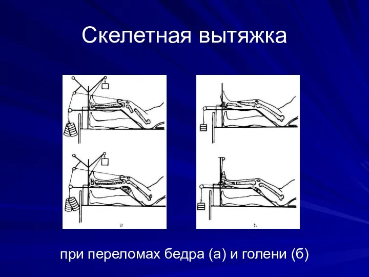 Скелетная вытяжка при переломах бедра (а) и голени (б)