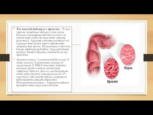 Тік ішектің қабынуы « проктит» - Үлкен дәретке отырғанда күйдіру