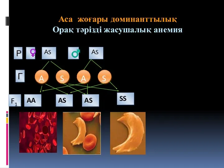 Аса жоғары доминанттылық Орақ тәрізді жасушалық анемия ♀ ♀ A