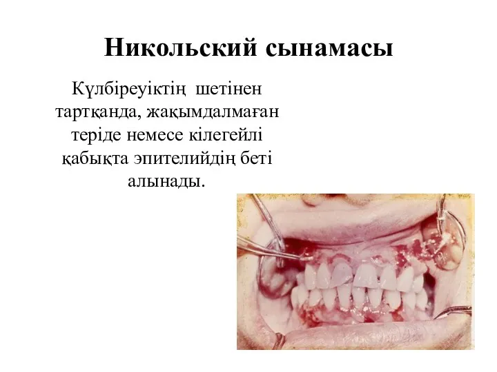 Никольский сынамасы Күлбіреуіктің шетінен тартқанда, жақымдалмаған теріде немесе кілегейлі қабықта эпителийдің беті алынады.