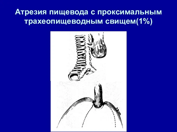 Атрезия пищевода с проксимальным трахеопищеводным свищем(1%)