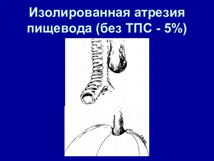 Изолированная атрезия пищевода (без ТПС - 5%)