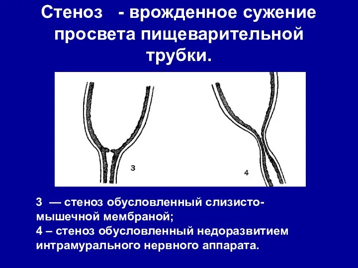 Стеноз - врожденное сужение просвета пищеварительной трубки. 3 — стеноз обусловленный слизисто-мышечной мембраной;