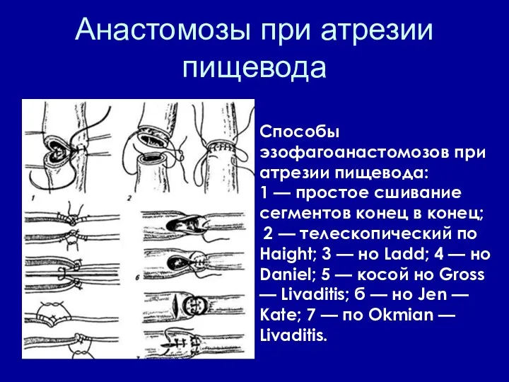 Анастомозы при атрезии пищевода Способы эзофагоанастомозов при атрезии пищевода: 1 — простое сшивание