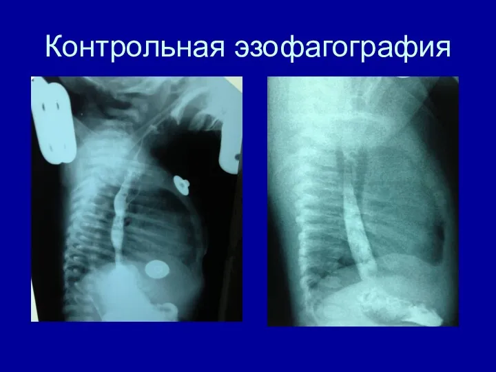 Контрольная эзофагография