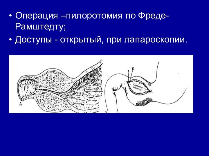 Операция –пилоротомия по Фреде-Рамштедту; Доступы - открытый, при лапароскопии.