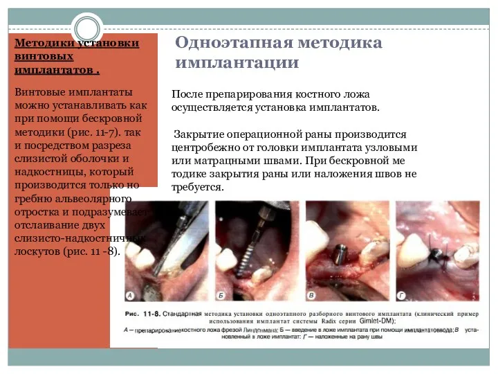 Одноэтапная методика имплантации Методики установки винтовых имплантатов . Винтовые имплантаты