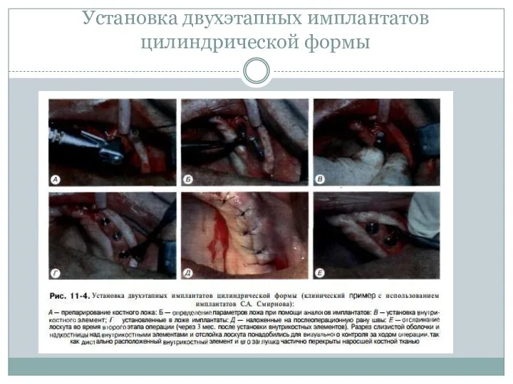 Установка двухэтапных имплантатов цилиндрической формы