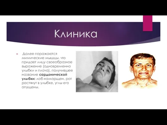 Клиника Далее поражаются мимические мышцы, что придает лицу своеобразное выражение