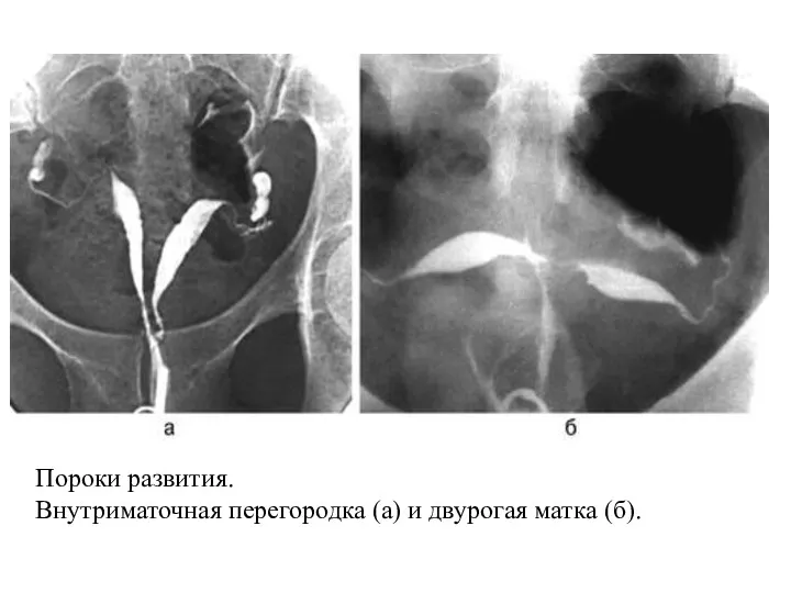 Пороки развития. Внутриматочная перегородка (а) и двурогая матка (б).