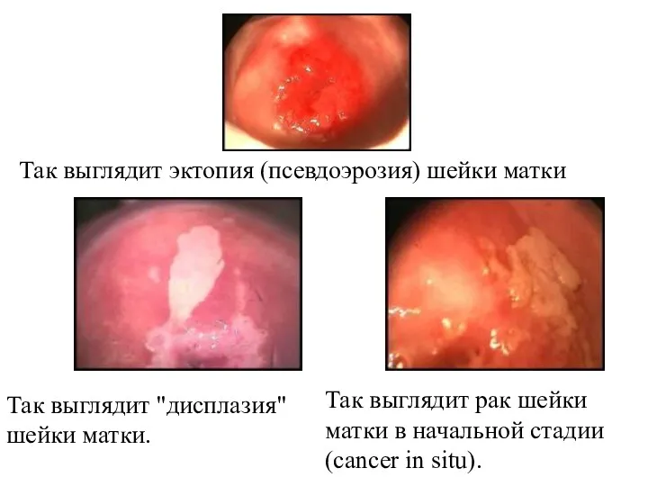 Так выглядит рак шейки матки в начальной стадии (cancer in