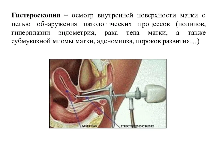 Гистероскопия – осмотр внутренней поверхности матки с целью обнаружения патологических