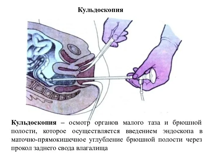 Кульдоскопия Кульдоскопия – осмотр органов малого таза и брюшной полости,