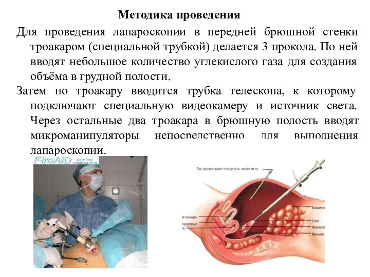 Методика проведения Для проведения лапароскопии в передней брюшной стенки троакаром