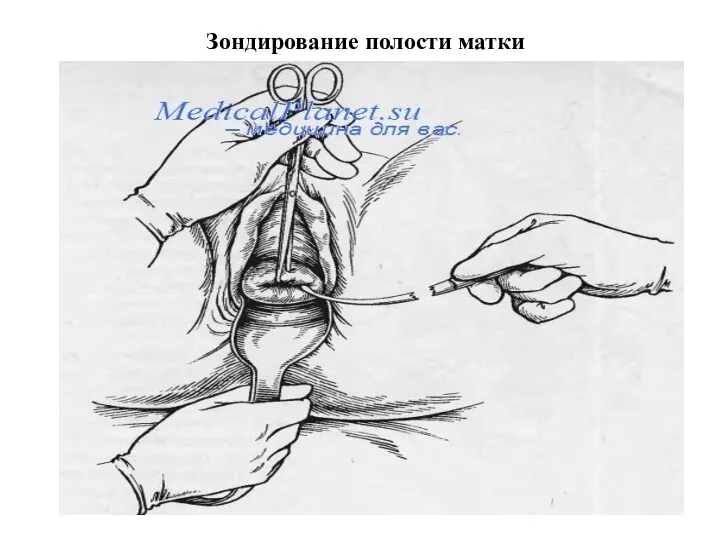 Зондирование полости матки