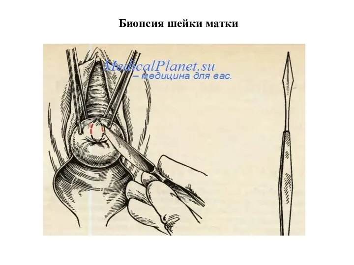 Биопсия шейки матки