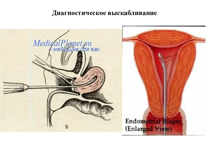 Диагностическое выскабливание