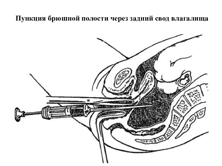 Пункция брюшной полости через задний свод влагалища