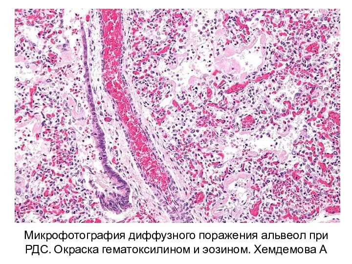 Микрофотография диффузного поражения альвеол при РДС. Окраска гематоксилином и эозином. Хемдемова А