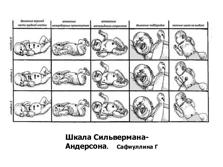 Шкала Сильвермана-Андерсона. Сафиуллина Г Абдурасулов Алишер