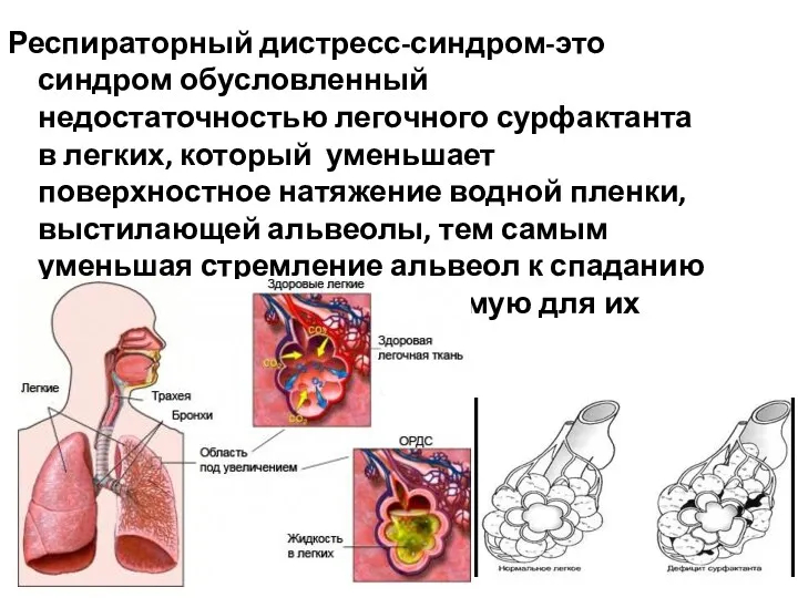 Респираторный дистресс-синдром-это синдром обусловленный недостаточностью легочного сурфактанта в легких, который уменьшает поверхностное натяжение