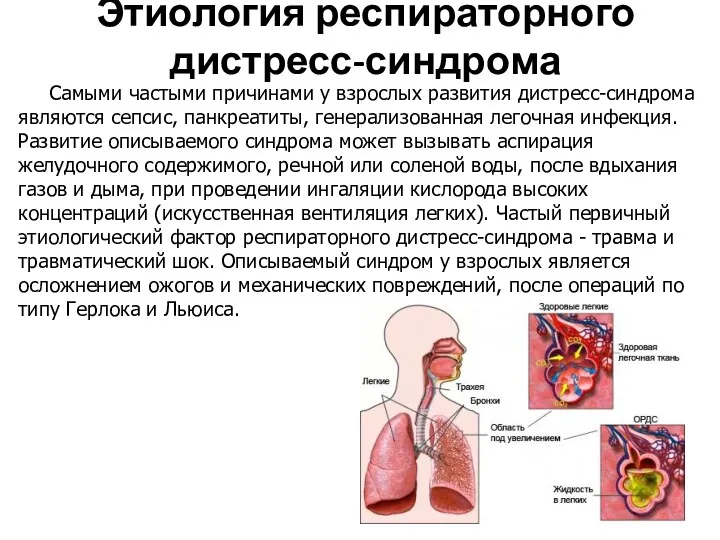 Этиология респираторного дистресс-синдрома Самыми частыми причинами у взрослых развития дистресс-синдрома являются сепсис, панкреатиты,