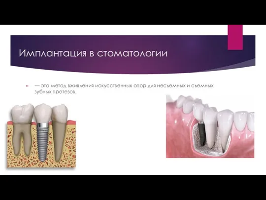 Имплантация в стоматологии — это метод вживления искусственных опор для несъемных и съемных зубных протезов.