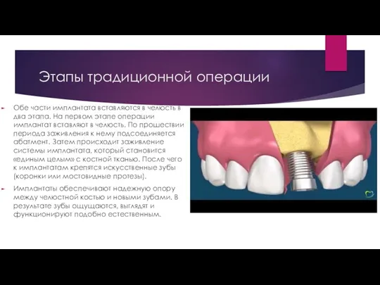 Этапы традиционной операции Обе части имплантата вставляются в челюсть в два этапа. На