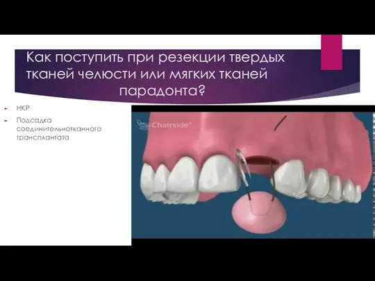 Как поступить при резекции твердых тканей челюсти или мягких тканей парадонта? НКР Подсадка соединительнотканного трансплантата