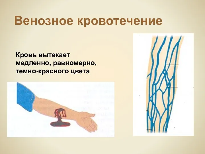 Венозное кровотечение Кровь вытекает медленно, равномерно, темно-красного цвета