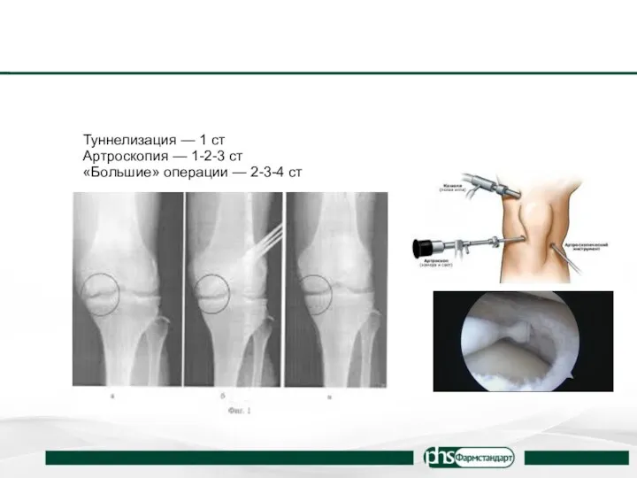 Туннелизация — 1 ст Артроскопия — 1-2-3 ст «Большие» операции — 2-3-4 ст