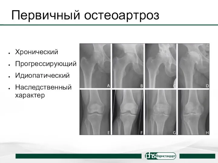 Первичный остеоартроз Хронический Прогрессирующий Идиопатический Наследственный характер