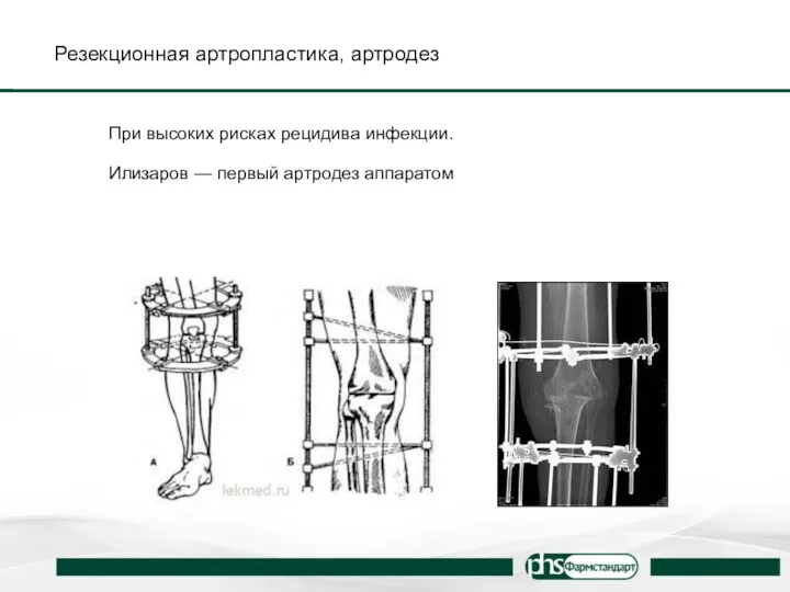 Резекционная артропластика, артродез При высоких рисках рецидива инфекции. Илизаров — первый артродез аппаратом