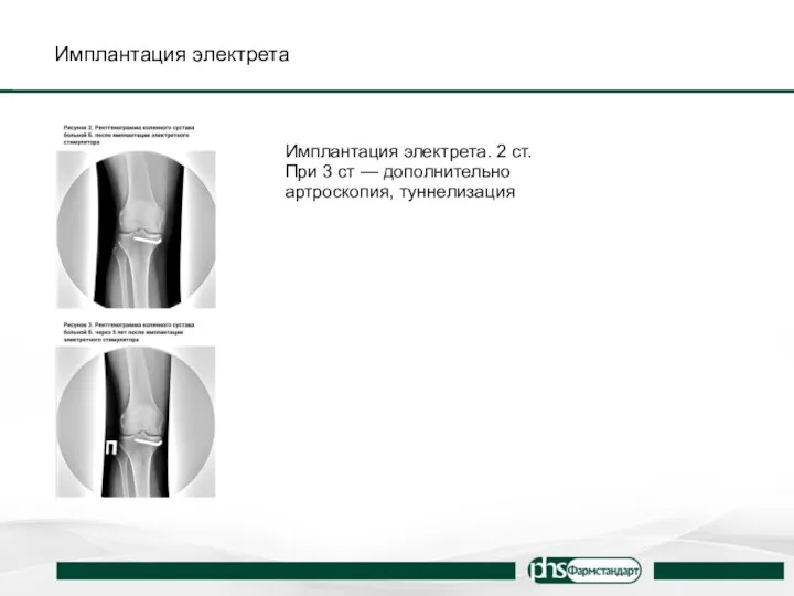 Имплантация электрета Имплантация электрета. 2 ст. При 3 ст — дополнительно артроскопия, туннелизация