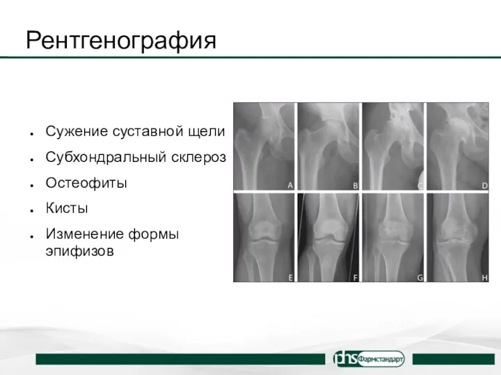 Рентгенография Сужение суставной щели Субхондральный склероз Остеофиты Кисты Изменение формы эпифизов