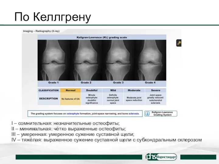 По Келлгрену I – сомнительная: незначительные остеофиты; II – минимальная: