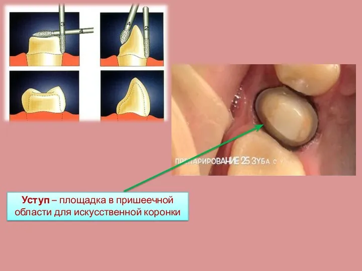 Уступ – площадка в пришеечной области для искусственной коронки