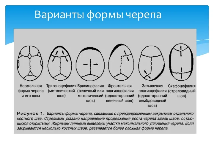 Варианты формы черепа