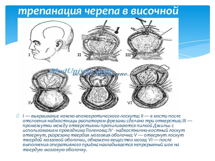 I — выкраивание кожно-апоневротического лоскута; II — в кости после