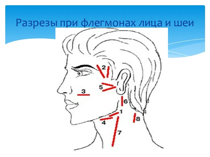 Разрезы при флегмонах лица и шеи