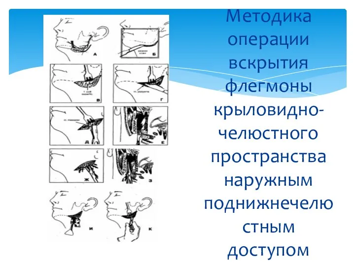 Методика операции вскрытия флегмоны крыловидно-челюстного пространства наружным поднижнечелюстным доступом