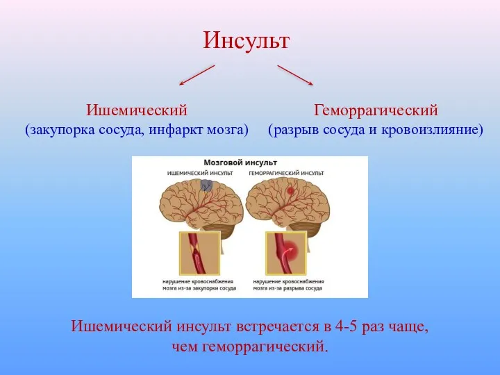 Инсульт Ишемический (закупорка сосуда, инфаркт мозга) Геморрагический (разрыв сосуда и