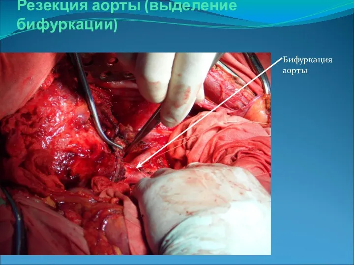 Резекция аорты (выделение бифуркации) Бифуркация аорты